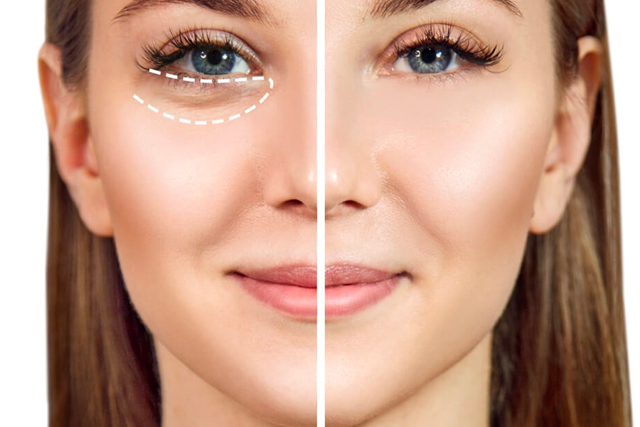 Reasons For And Ways To Treat Under Eye Bags