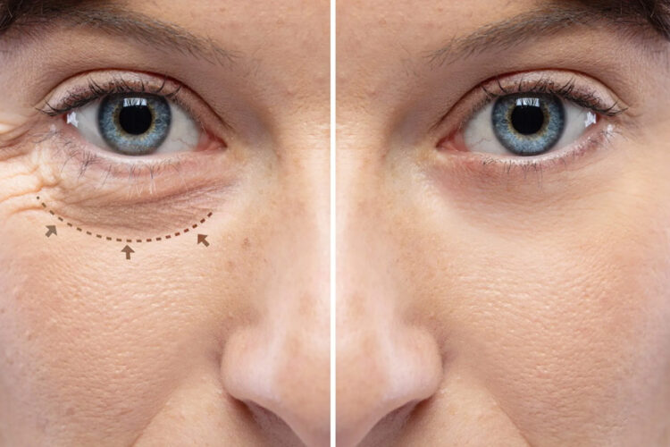 Discovering The Importance Of Eye Bag Surgery